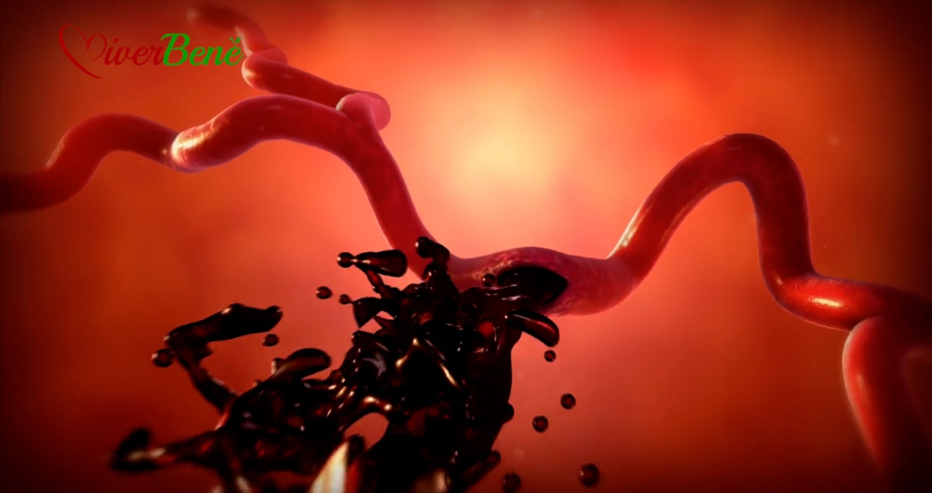 L'ictus nei giovani è una patologia in aumento anche nel bresciano